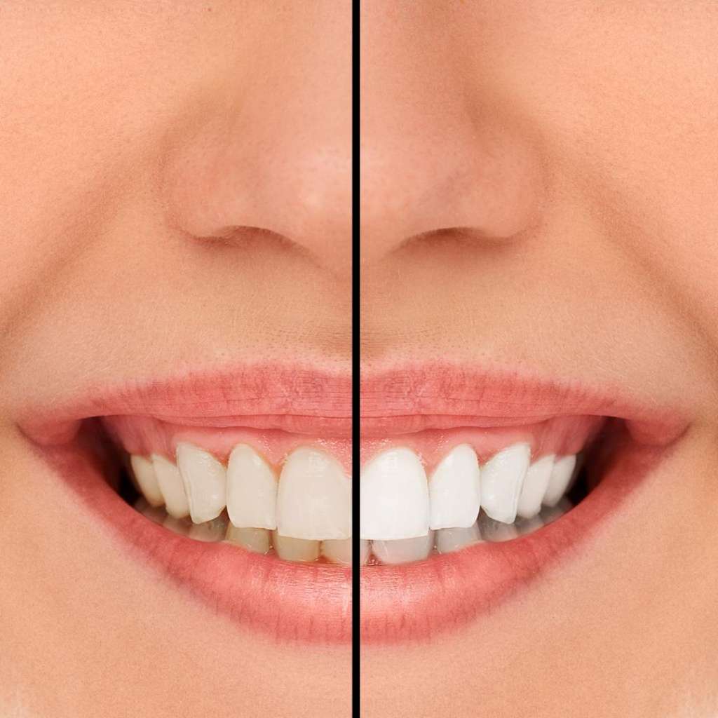 Улыбка, которая заставляет засиять: 5 преимуществ отбеливания зубов
